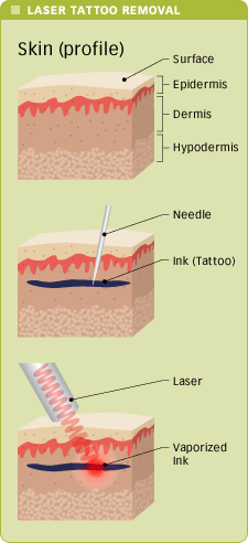 How a Tattoo Removal Process Works | Affordable Tattoo Removal | Cheap ...